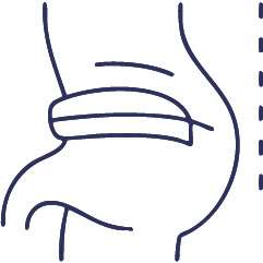 جراحة الفتق